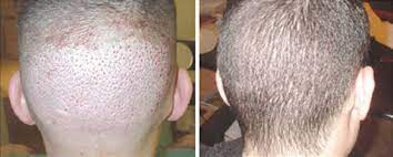 Patient image showing before and after FUE Hair Transplant