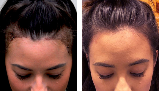 26-year-old-female-6-months-s-p-650-grafts-to-the-hairline - Denver Hair  Surgery