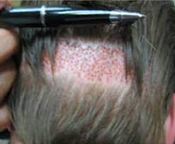 Backside of hair and scalp picture of a patient immediately after FUE procedure