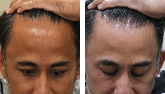 Which is Best Hair Transplant Clinic in India and What Cost?