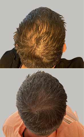 Before After Image of Hair Restoration