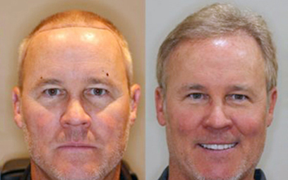 Before After Image 2 of Hair Restoration Gallery