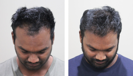 30 year old male before and after patient image