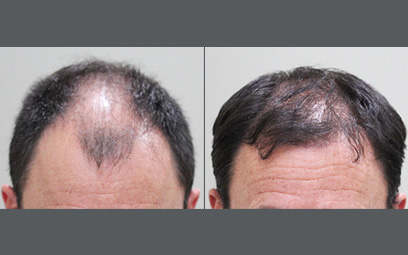 Before After Image 1 of Hair Restoration Gallery
