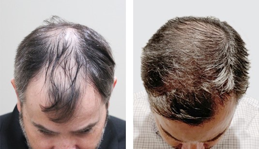 49 year old male after 2522 grafts before and after patient image