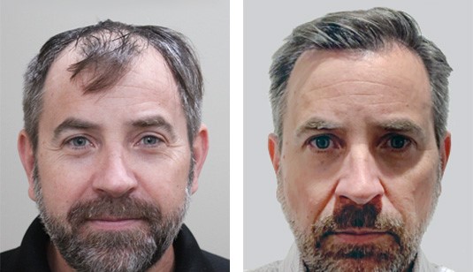 49 year old male after 2522 grafts before and after patient image