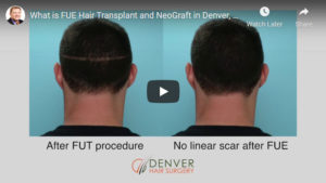What is FUE Hair Transplant and Neograft in Denver, CO - Click to see video