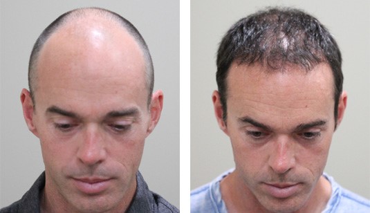 43 Year old male after 3000 grafts before and after patient image