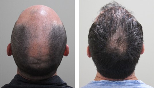 43 Year old male after 3000 grafts before and after patient image