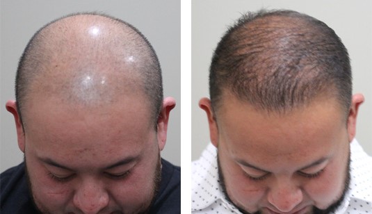35 year old male, 6 months after 3000 grafts to the hairline and top of the scalp before and after patient image