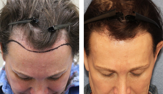 49 year old patient, 10 months after 1090 grafts to the hairline before and after patient image