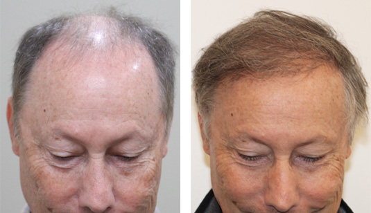 67 year old patient, 1 year after 2500 grafts to the hairline before and after patient image