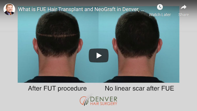 Denver Hair Surgery TV Spot
