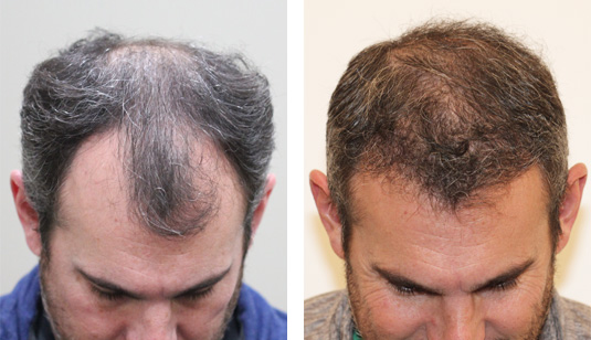 44 year old male, 1 year after 2000 grafts to the hairline and crown before  and after patient image - Denver Hair Surgery