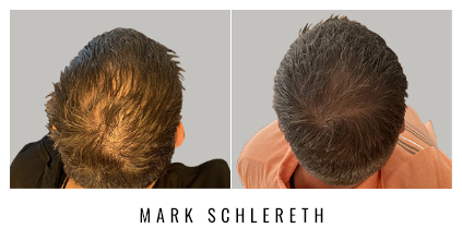 Mark Schlereth before and after image