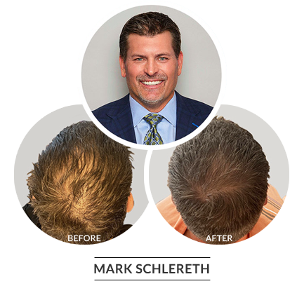 Mark schlereth before and after image