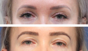 40 year old female, 1 year after one hair transplant to brows.