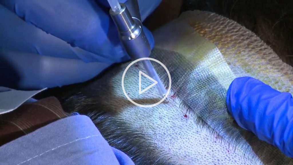 Image of The NeoGraft Procedure Click to See Video