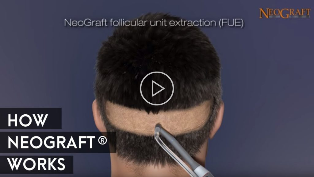 Image of Animation on How NeoGraft® Works Click to See Video