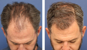 47 year old male, 7 months after FUE transplant; 3000 grafts to the hairline and midscalp.