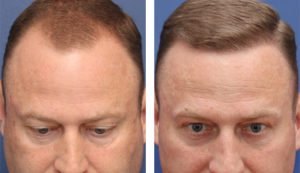 49yo male 1y s/p 2500 grafts to hairline.