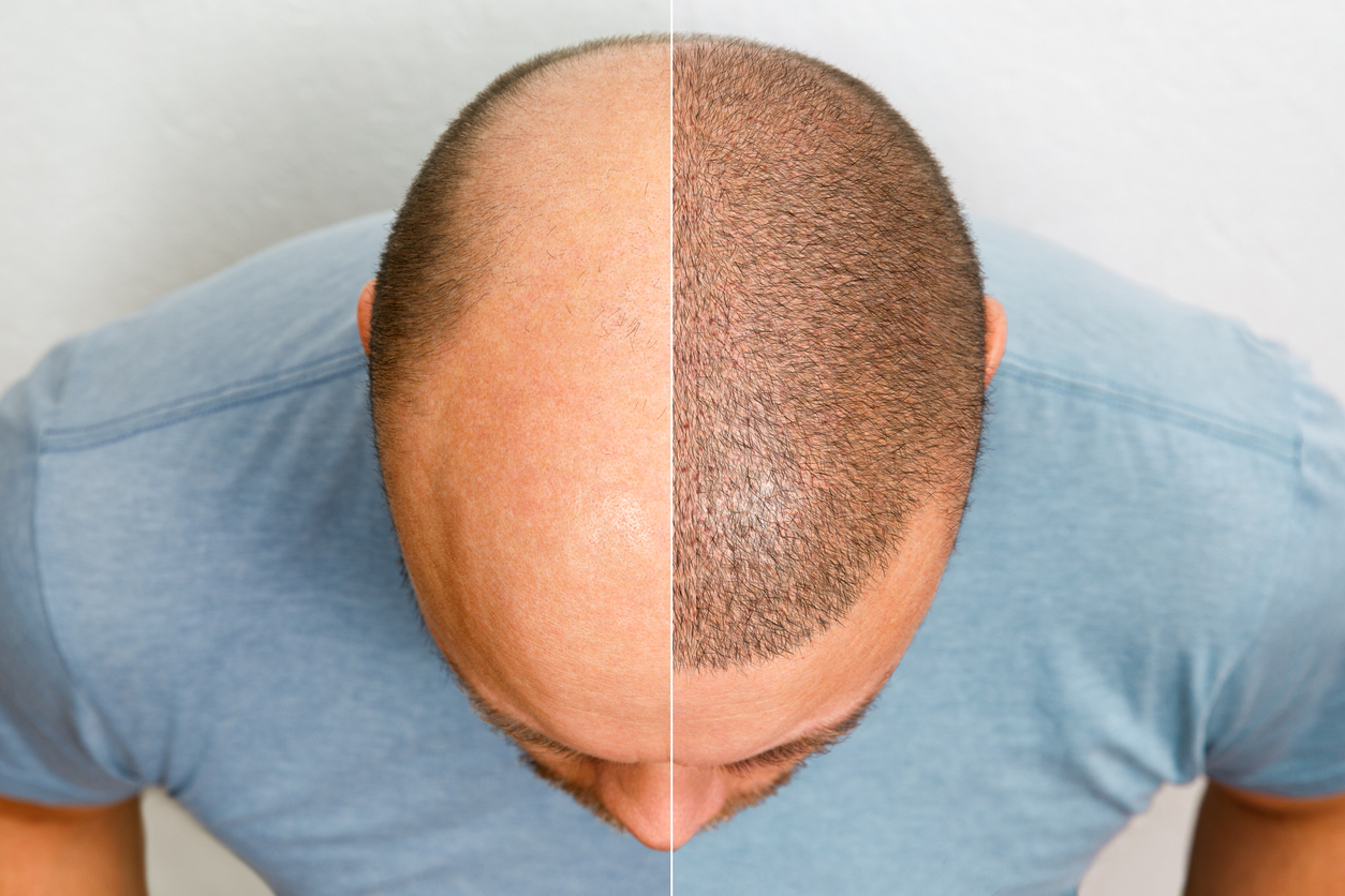 The image shows a before and after of a man who has undergone hair restoration to show how FUE and other hair transplants differ.