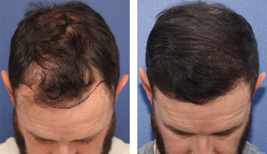 40 year old male, 1 year after FUE transplant; 2500 grafts to the hairline and crown.