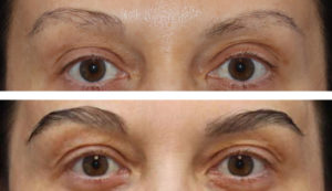 47 year old female, 6 months after one hair transplant to brows.