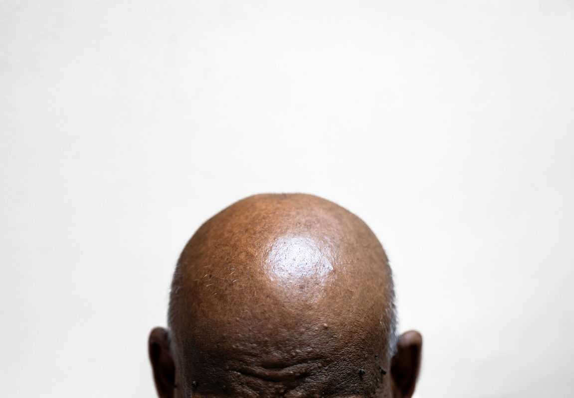 Featured image for Does Balding Ever Indicate Health Complications