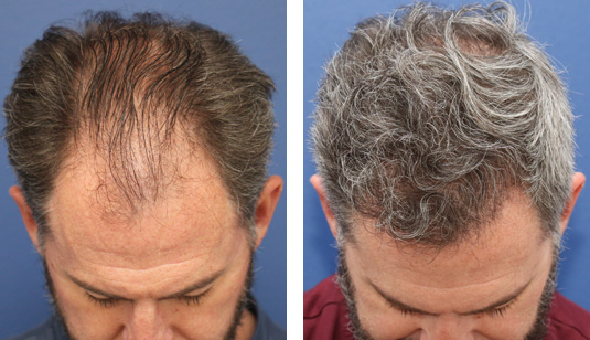 47 year old male, 1 year after FUE transplant; 3000 grafts to the hairline and midscalp.