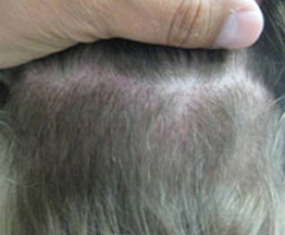 Backside of hair and scalp picture of a patient after 2 weeks of FUE procedure