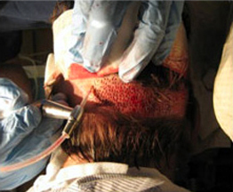 Backside of hair and scalp picture of a patient during FUE procedure