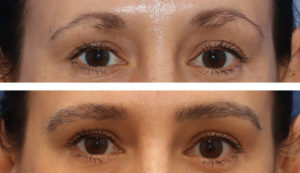 43 year old female, 6 months after one hair transplant to brows.