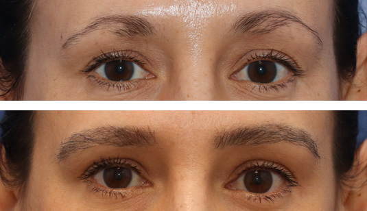 43 year old female, 6 months after one hair transplant to brows.