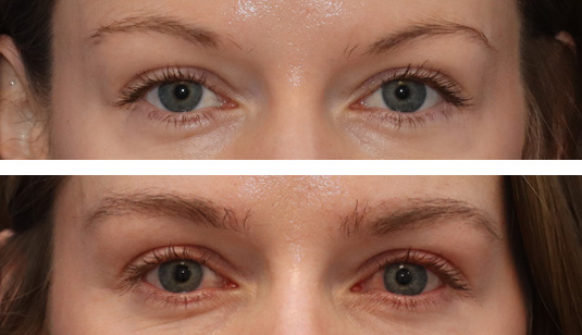 31 year old female, 3 months after one hair transplant to brows. The grafts will continue to grow and improve density for up to a year.