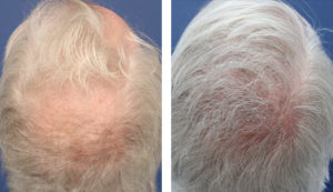 54 year old male, 1 year after FUE transplant; 2414 grafts to the crown