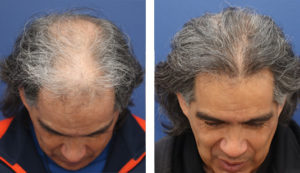 58 year old male, 1 year after FUE transplant; 2500 grafts to the hairline and midscalp.