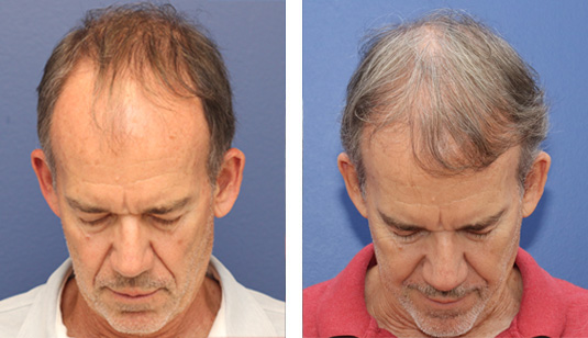 63 year old male, 1 year after FUE transplant; 2816 grafts to the hairline and crown. 63 year old male, 1 year after FUE transplant; 2816 grafts to the hairline and crown.