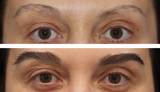47 year old female, 1 year after one hair transplant to brows. 47 year old female, 1 year after one hair transplant to brows.
