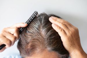 Featured image for What Is the Best Method of Hair Restoration