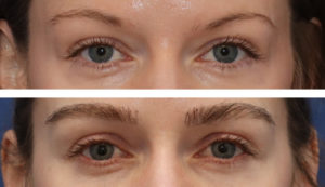 31 year old female, 1 year after one hair transplant to the brows.