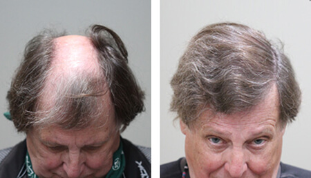 70-year-old-male-before-and-after 1 (1)