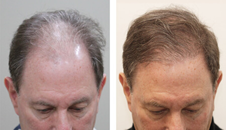 fue-hair-transplant-patient23 1 (1)