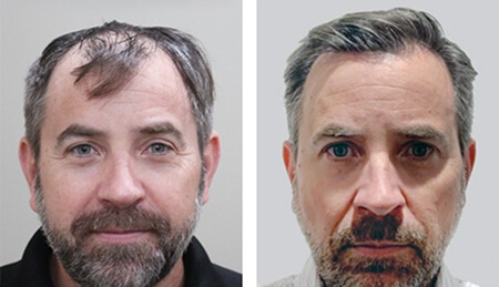 hair-transplant-before-and-after-1b 1 (1)