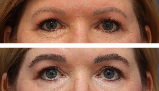 54 year old female 1 year after one hair transplant to brows 54 year old female 1 year after one hair transplant to brows